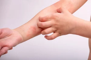 Eczéma enfant